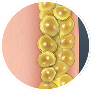 Cryolipolyse - Fat Freezing Breda